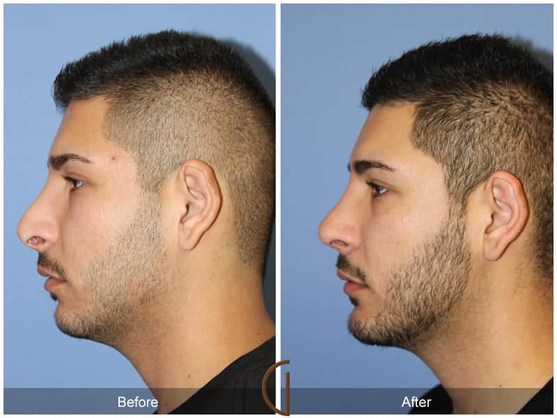 Rhinoplasty Huntington Beach CA 107 Image