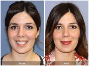 Revision Rhinoplasty Irvine CA