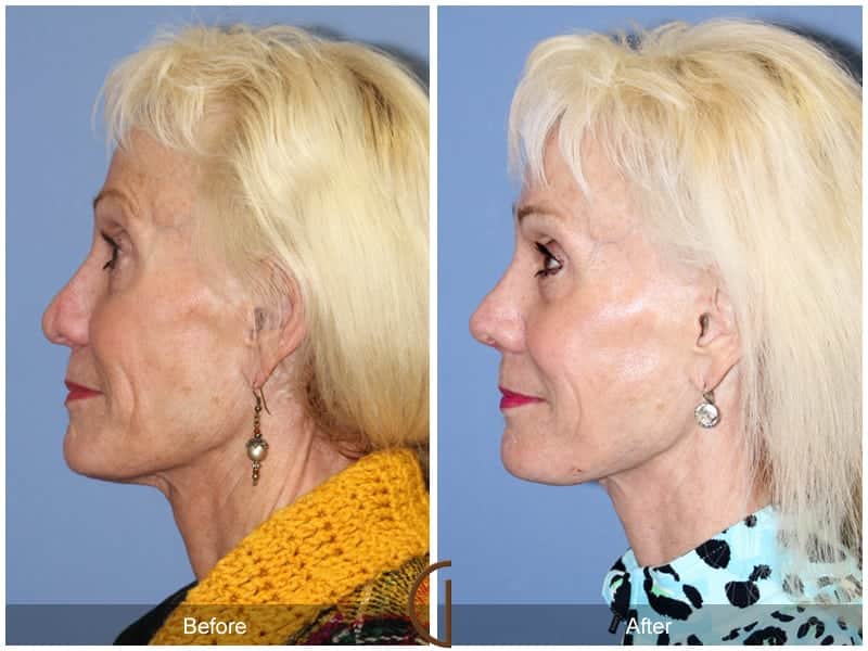 Rhinoplasty Long Beach CA 102 Image