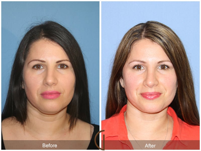 Rhinoplasty San Clemente CA -106 Image