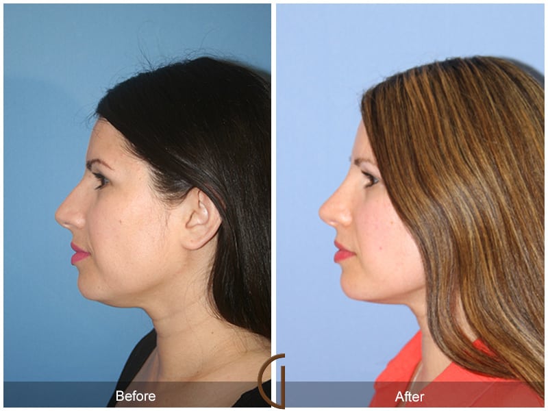 Rhinoplasty San Clemente CA -106 Image