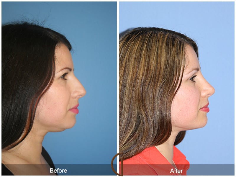 Rhinoplasty San Clemente CA -106 Image