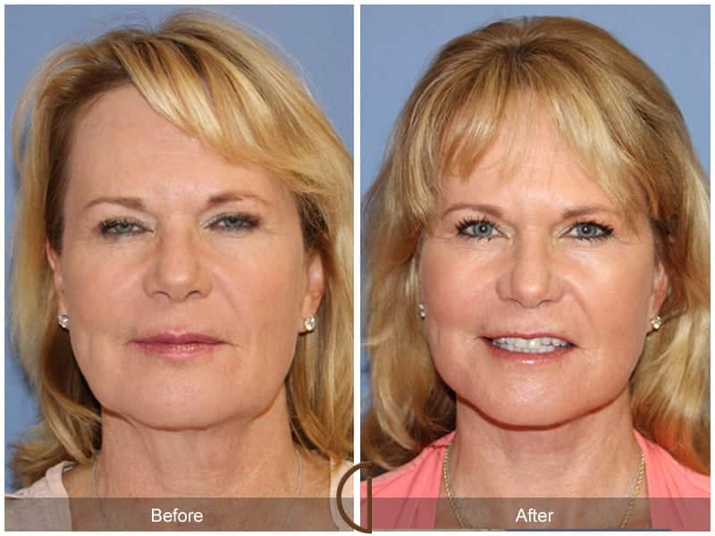 Facelift Newport Beach 209 Image