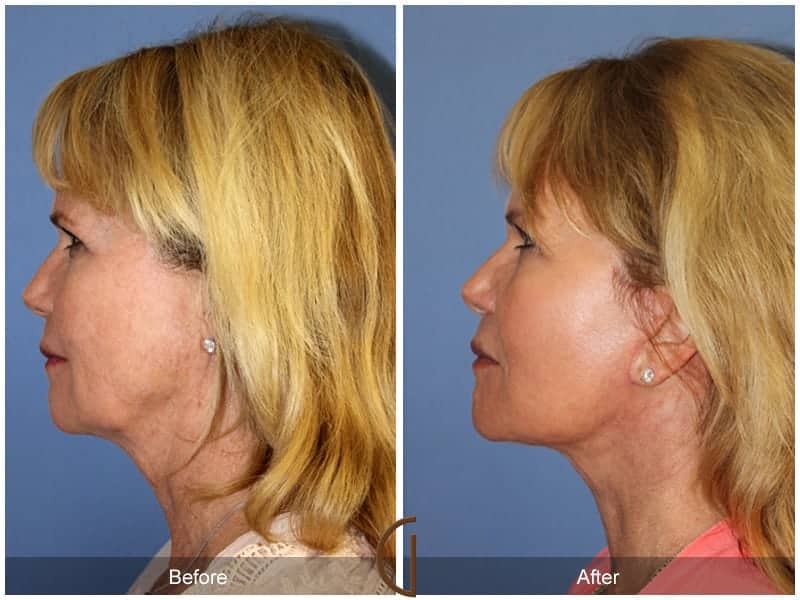 Facelift Newport Beach 209 Image