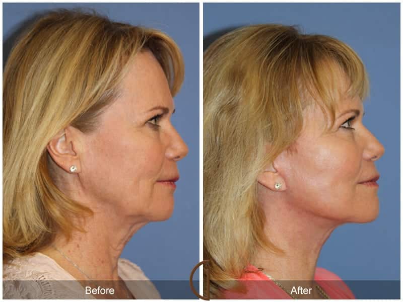 Facelift Newport Beach 209 Image