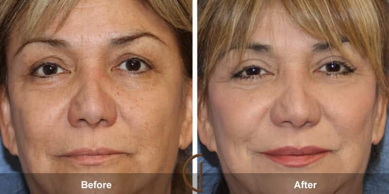 Eyelid Surgery Orange County 30 Image