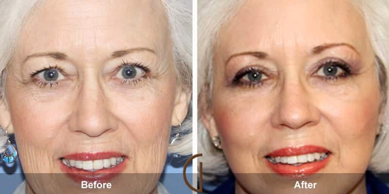 Eyelid Surgery Orange County 29 Image