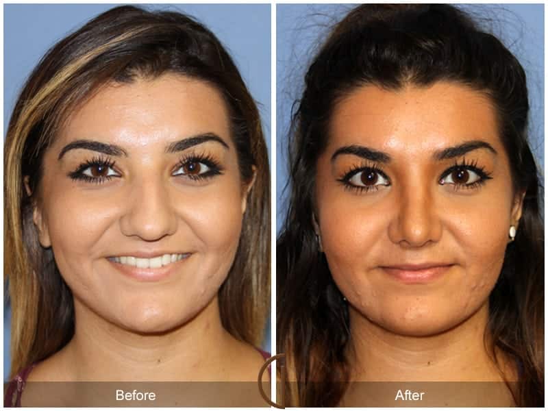 Ethnic Rhinoplasty Orange County 94 Image