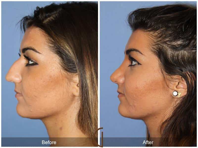 Ethnic Rhinoplasty Orange County 94 Image