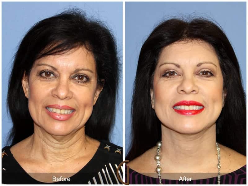 Facelift Newport Beach 207 Image