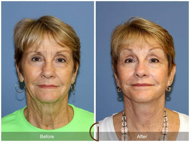 Facelift Newport Beach 206 Image