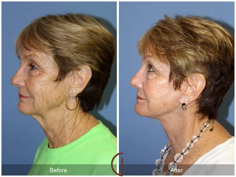 Facelift Newport Beach 206 Image