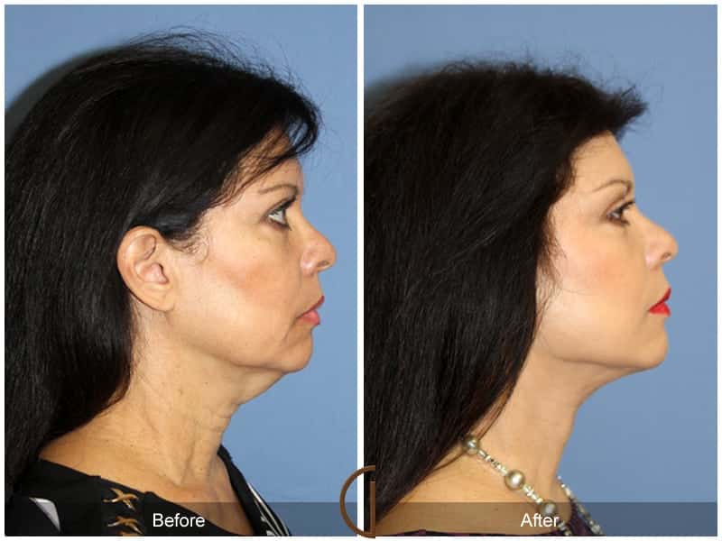 Facelift Newport Beach 207 Image