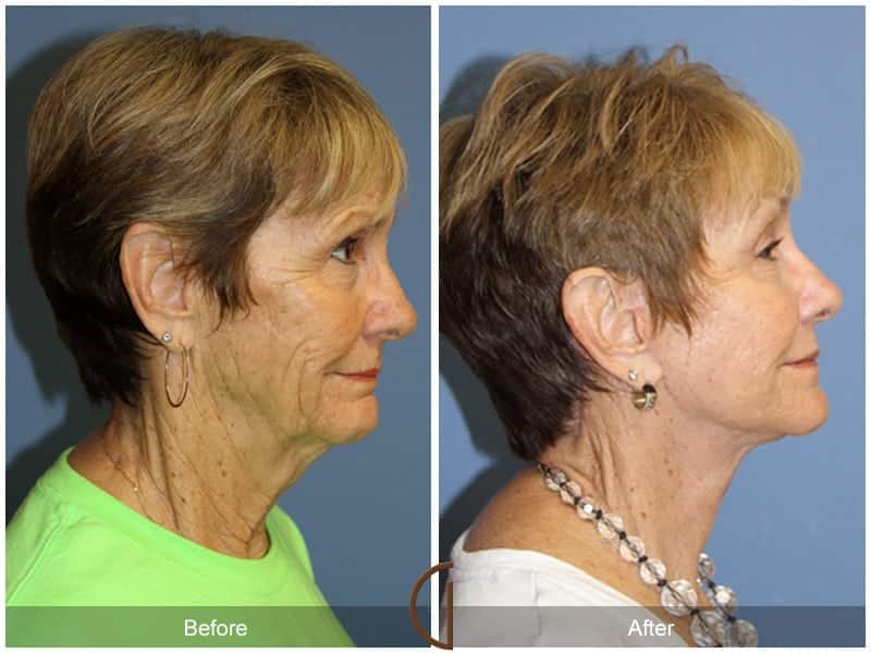 Facelift Newport Beach 206 Image