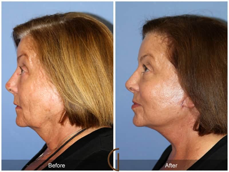Facelift Newport Beach 208 Image
