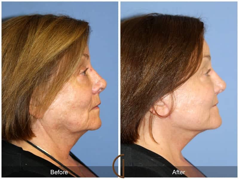 Facelift Newport Beach 208 Image