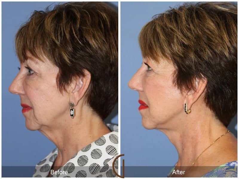 Facelift Newport Beach 178 Image