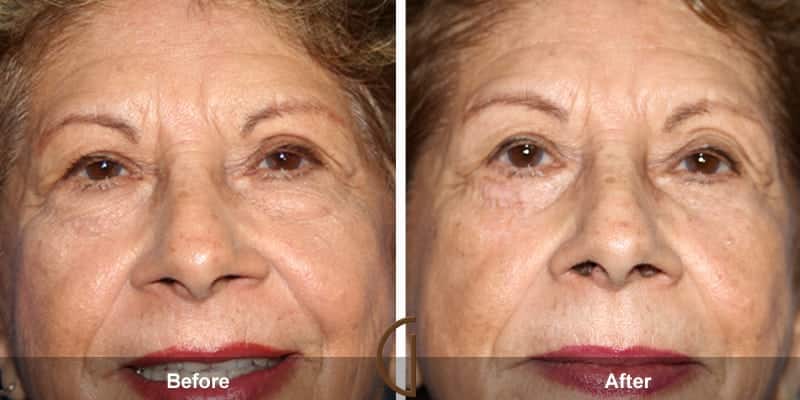 Eyelid Surgery Orange County 28 Image