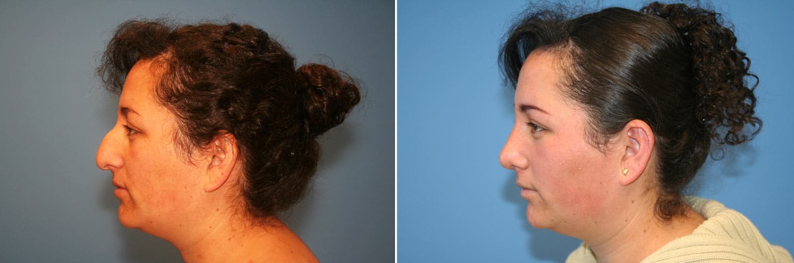 Specific Risks Associated with Ethnic Plastic Surgery Image