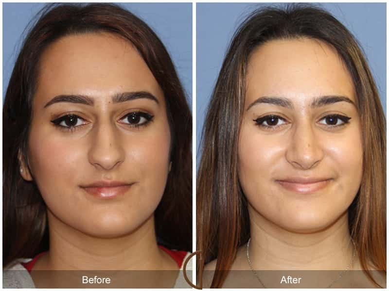 Ethnic Rhinoplasty Orange County 95 Image