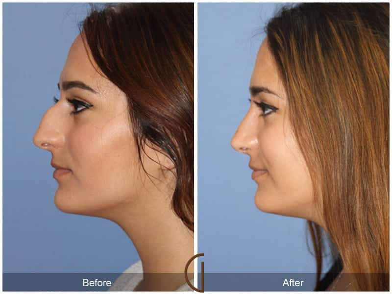 Ethnic Rhinoplasty Orange County 95 Image