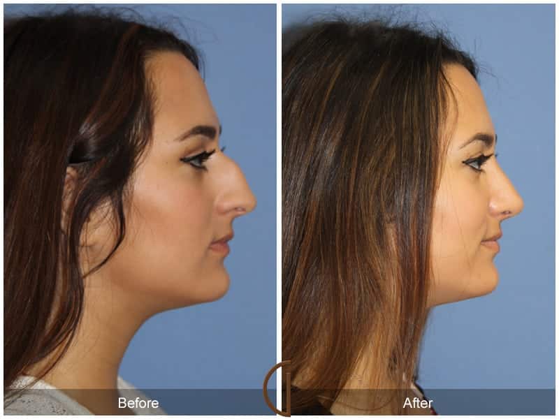 Ethnic Rhinoplasty Orange County 95 Image