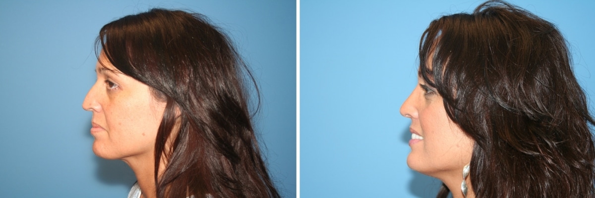 Three Ways to Speed up a Nose Job Recovery Image