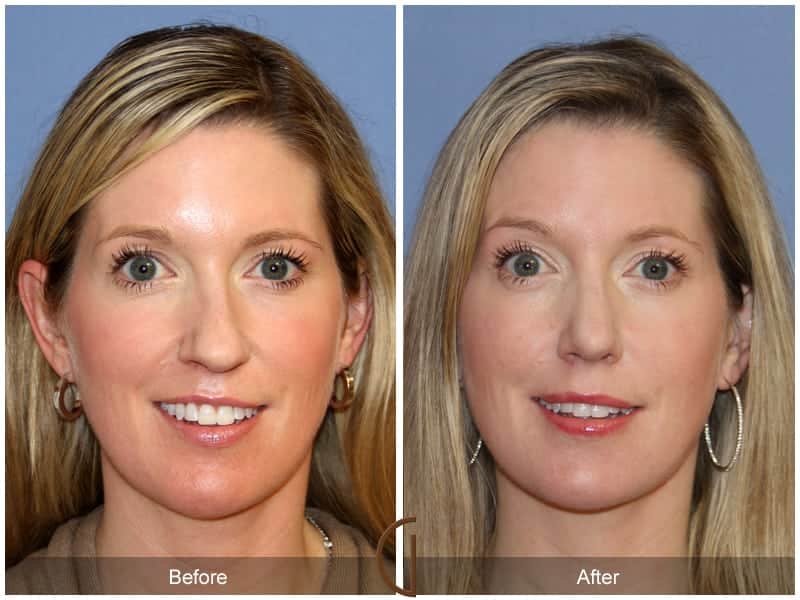 Tip Rhinoplasty Irvine CA 2 Image