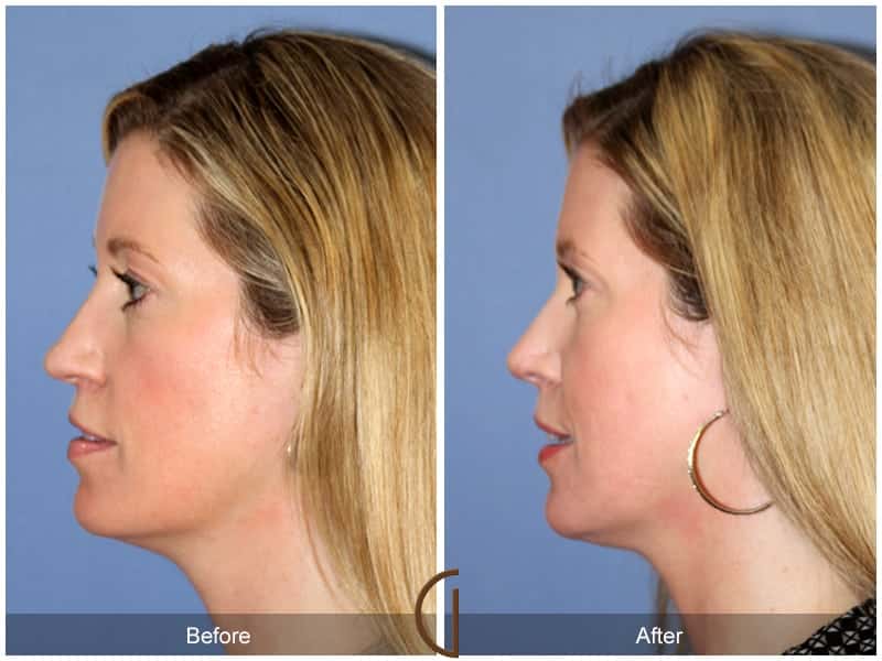 Tip Rhinoplasty Irvine CA 2 Image