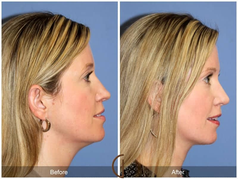 Tip Rhinoplasty Irvine CA 2 Image