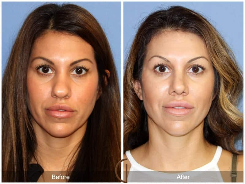 Tip Rhinoplasty Laguna Beach CA 4 Image