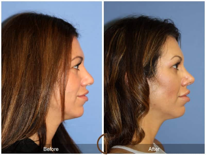 Tip Rhinoplasty Laguna Beach CA