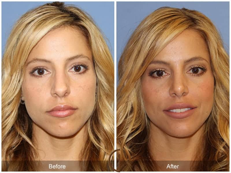 Tip Rhinoplasty Long Beach CA 3 Image
