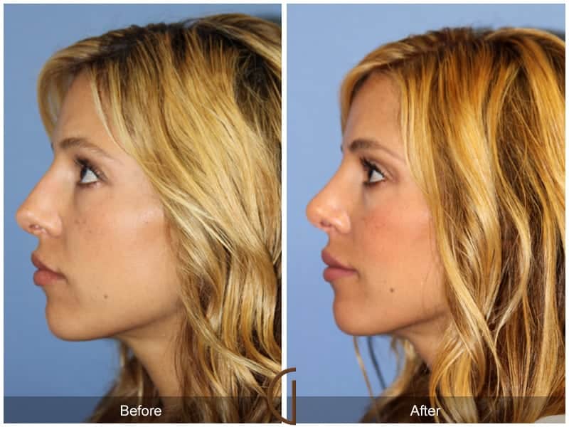 Tip Rhinoplasty Long Beach CA 3 Image