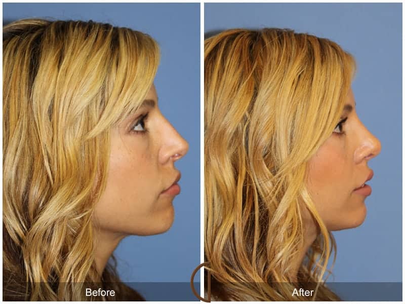 Tip Rhinoplasty Long Beach CA 3 Image