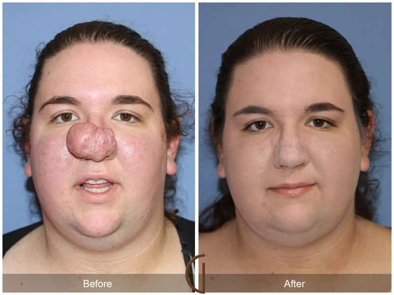 Tip Rhinoplasty Newport Beach 1 Image
