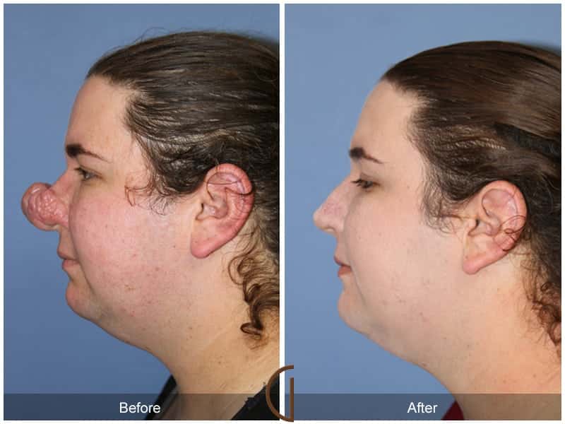 Tip Rhinoplasty Newport Beach 1 Image