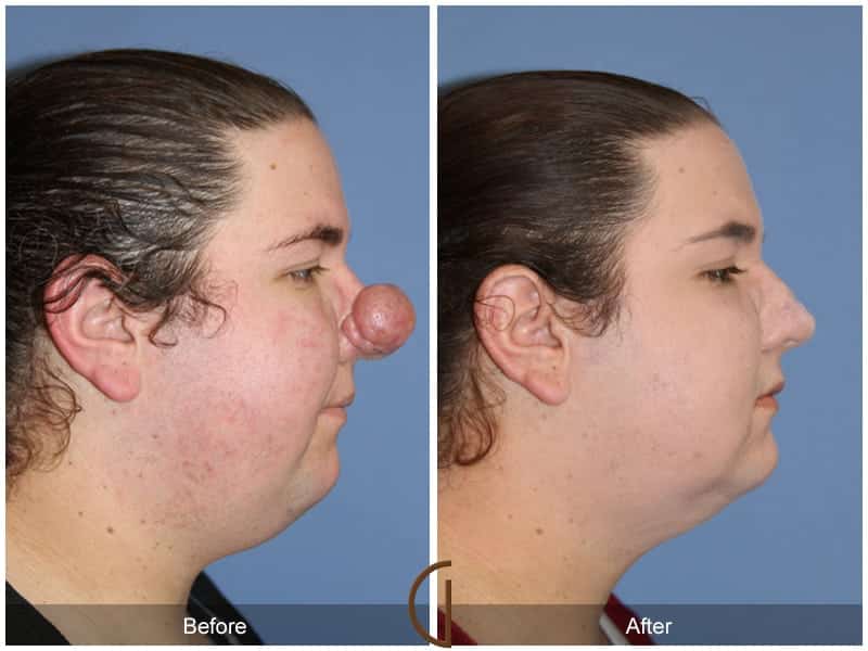 Tip Rhinoplasty Newport Beach 1 Image