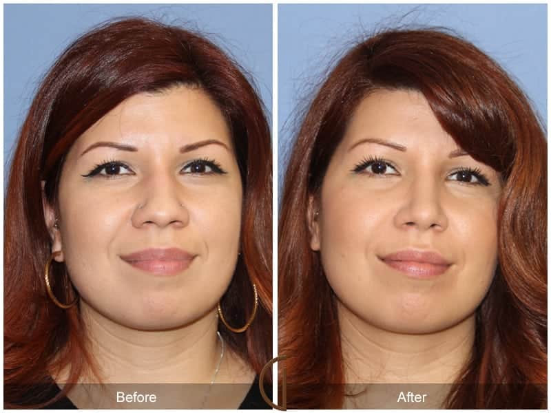 Ethnic Rhinoplasty Cypress CA 117 Image
