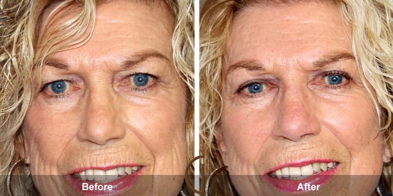 Eyelid Surgery Orange County 25 Image