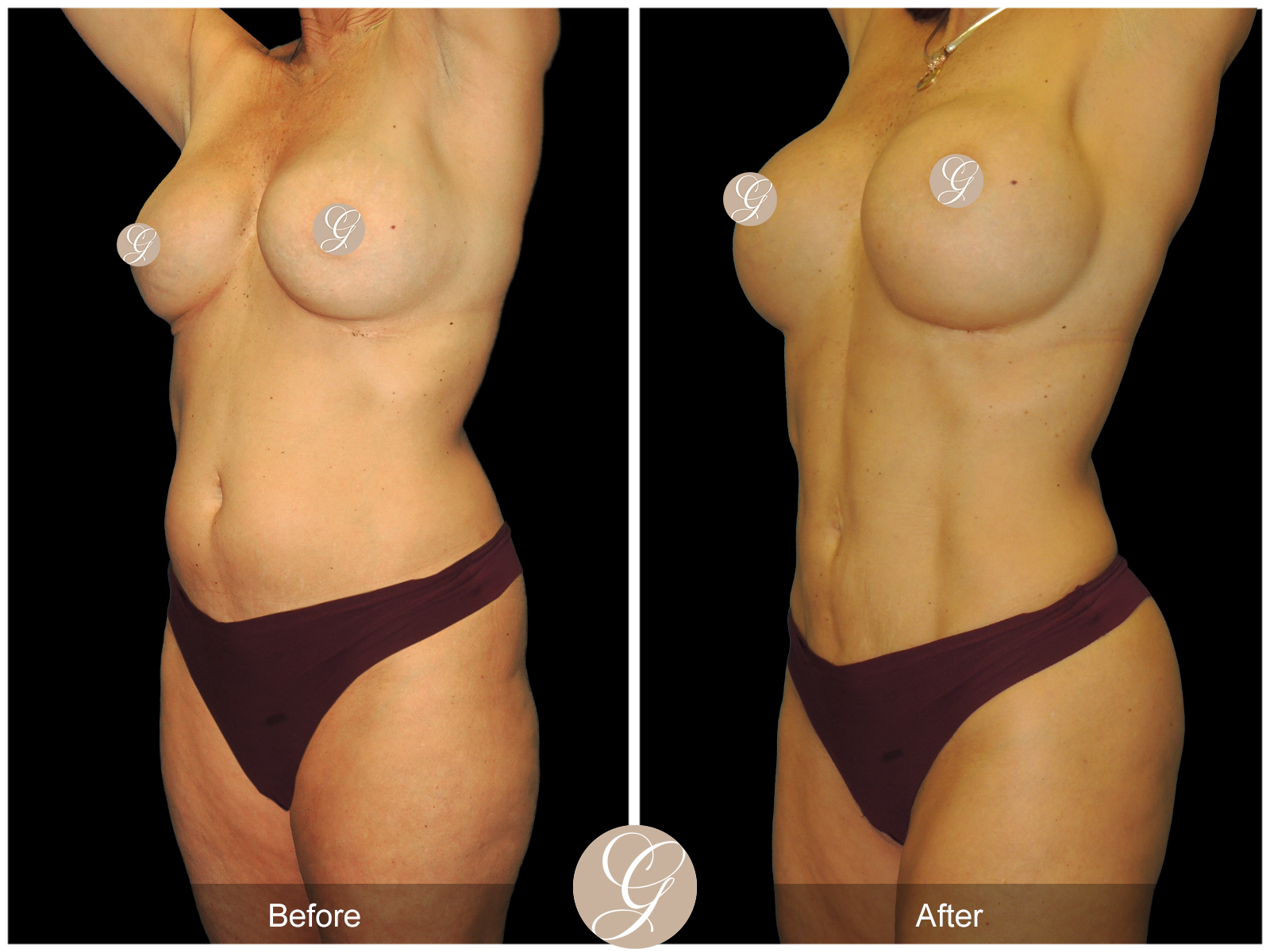 VASER 360 HIGH DEFINITION BODY SCULPTING PT9 Image