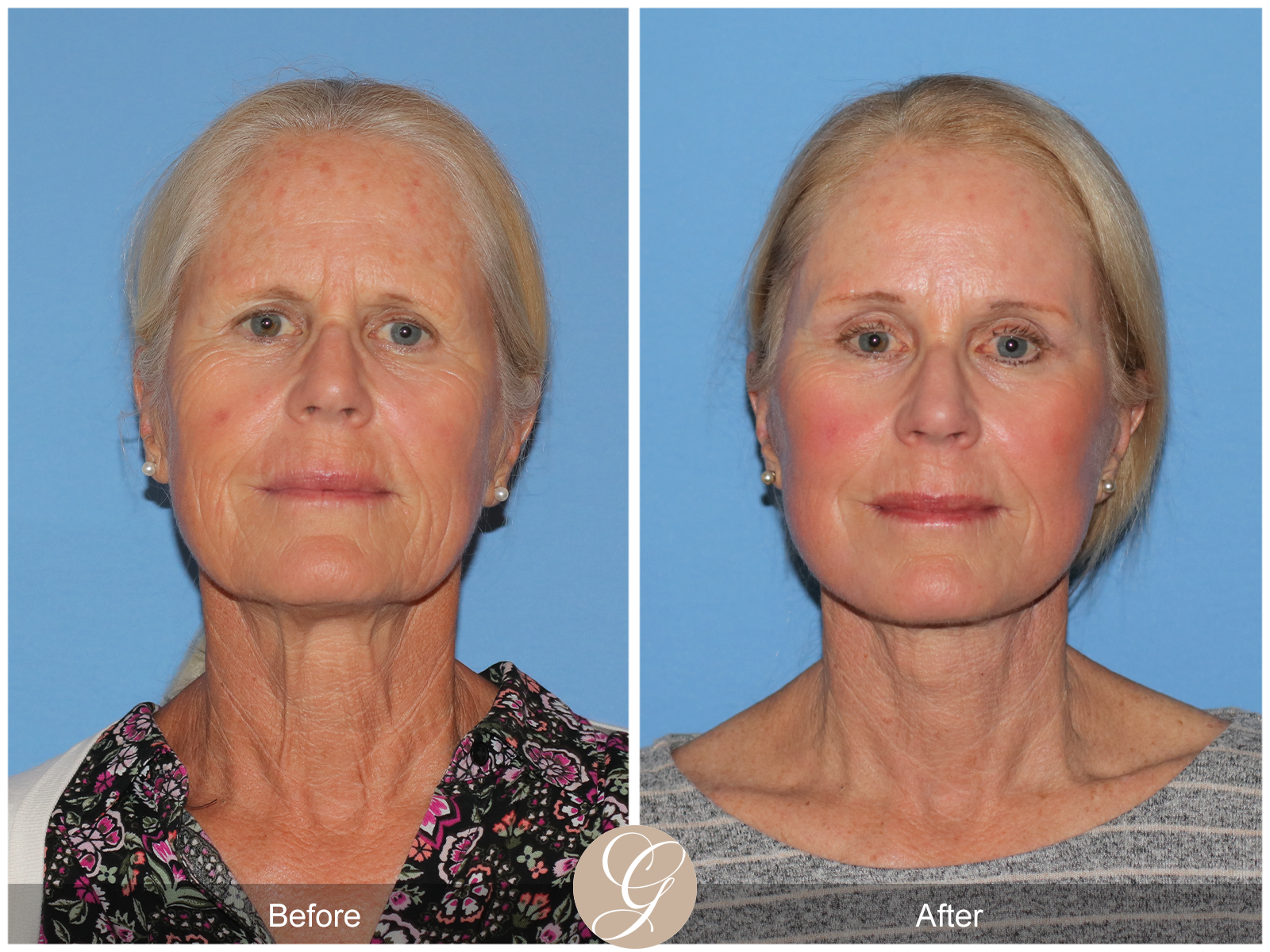 Preservation Facelift Case 23 Image