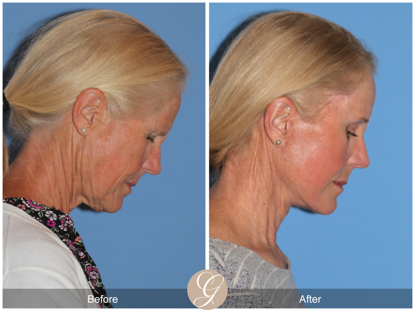 Preservation Facelift Case 23 Image