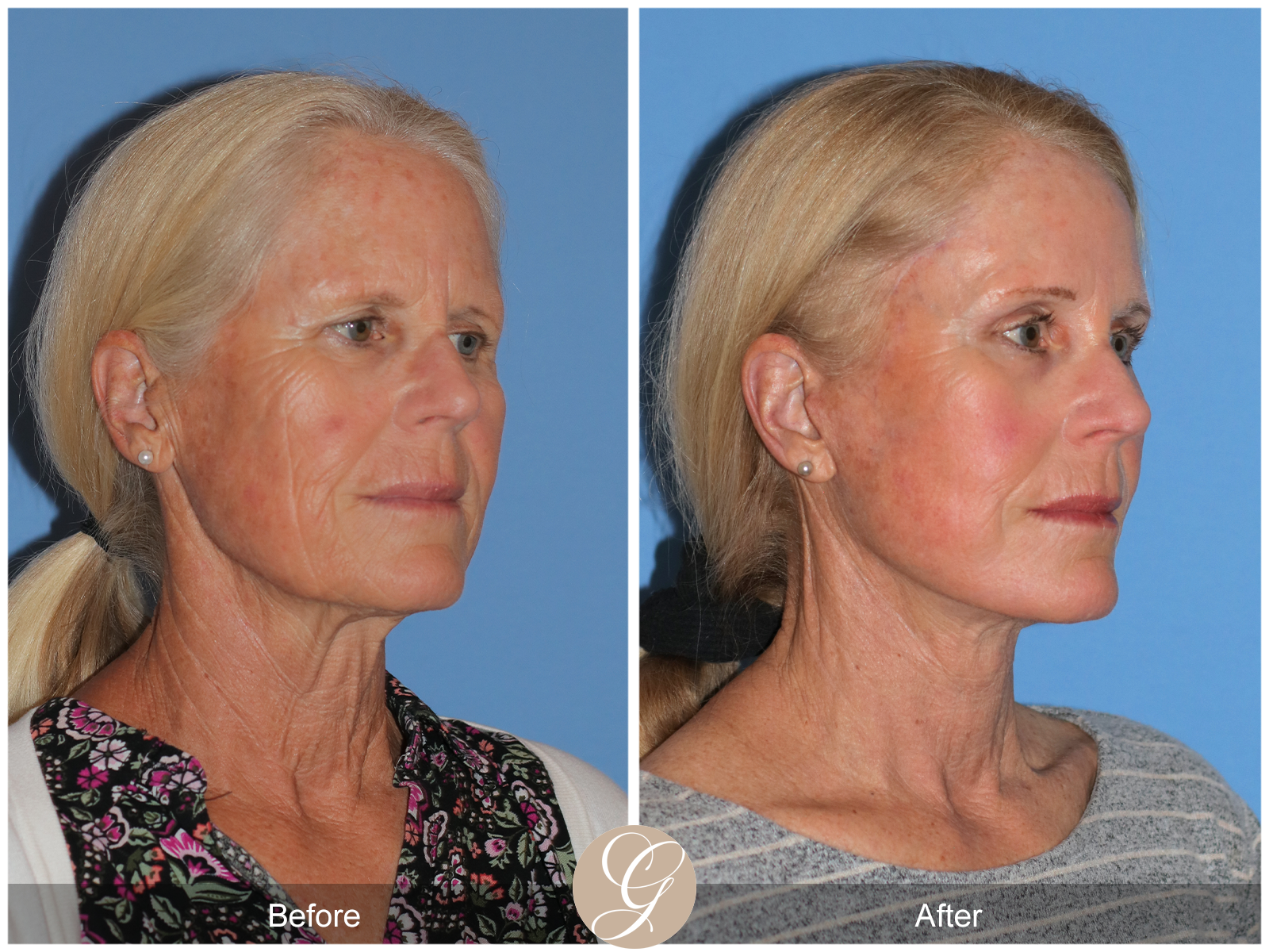 Preservation Facelift Case 23 Image