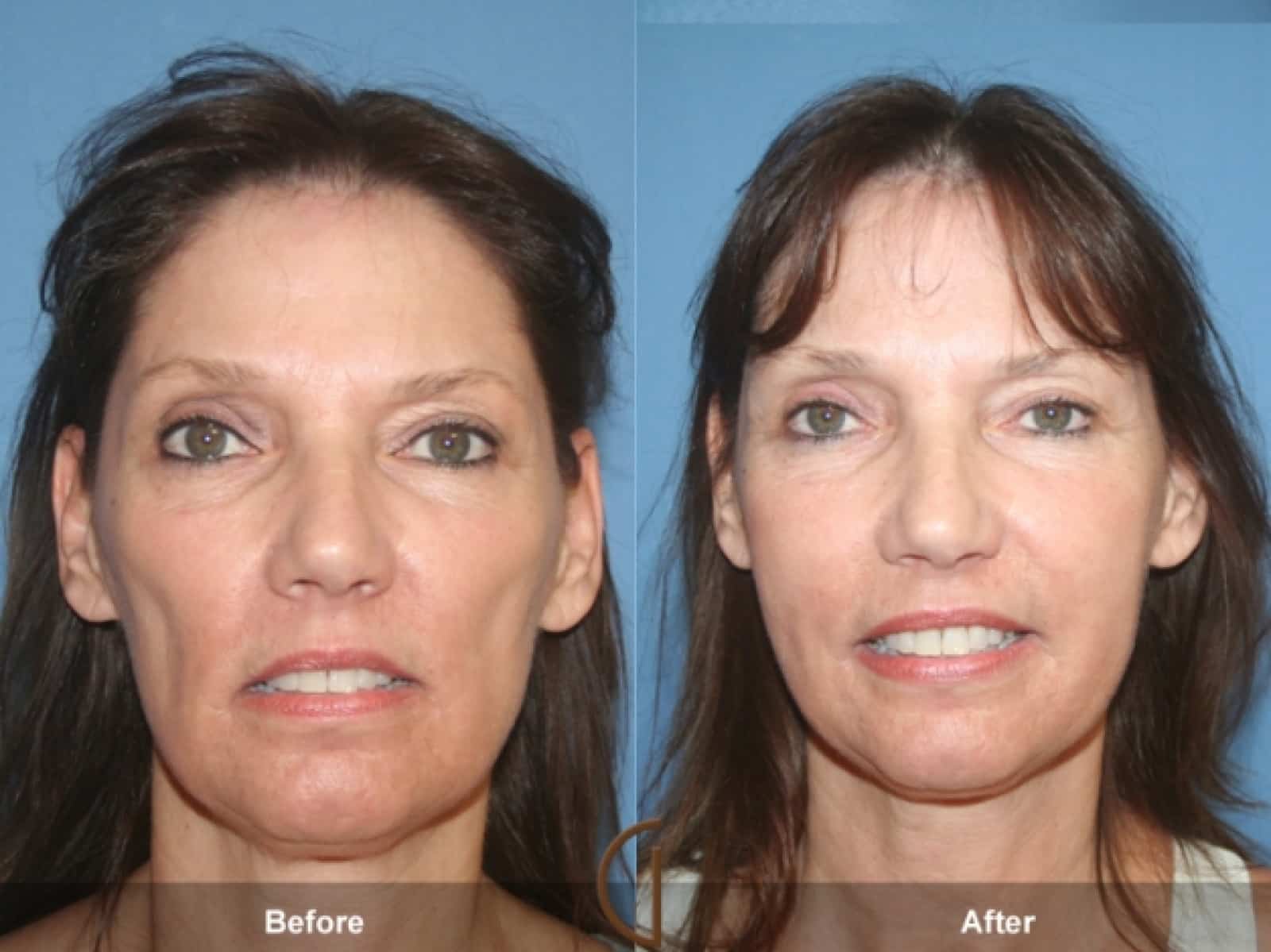 What is a Liquid Facelift? Image
