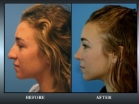 What is the Right Age to Have Cosmetic Surgery? Image