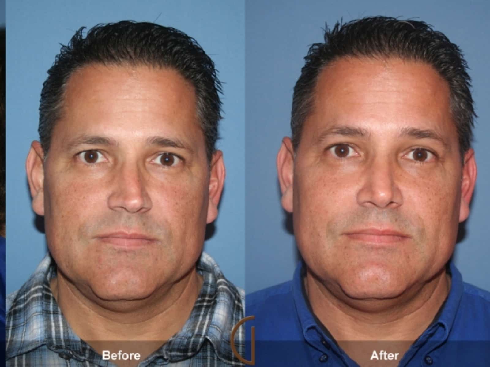 The Complications of a Broken Nose Image