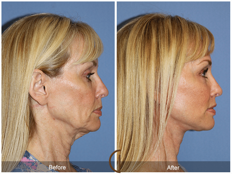 Which Facelift is Right for You? Image