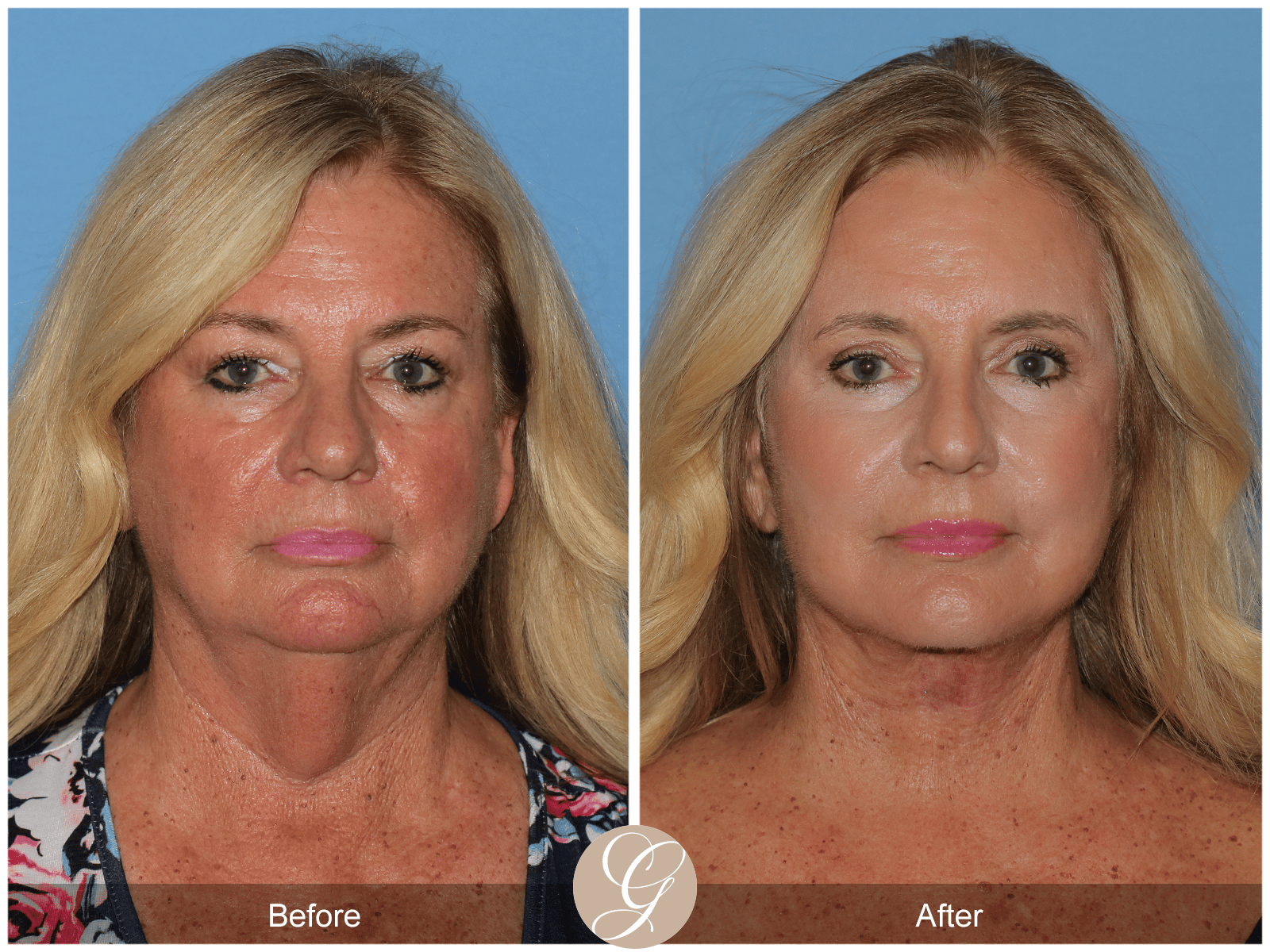 Deep Plane Facelift & Deep Plane Necklift Case 2