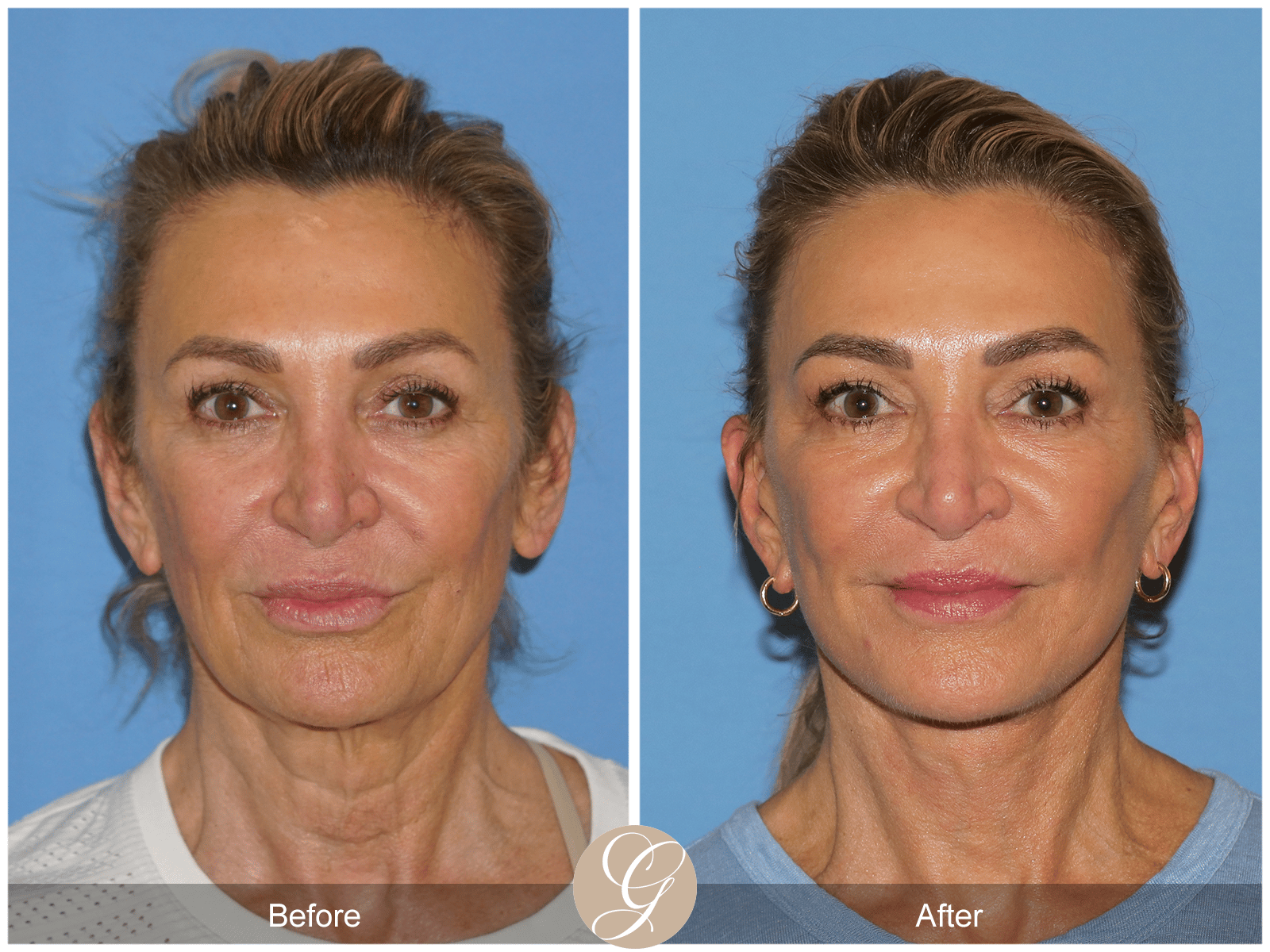 Deep Plane Facelift Case 1 Image